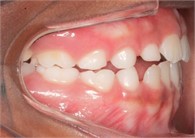 Photos eight months after treatment initiation: a) front intraoral photo; b) right lateral intraoral photo; c) left lateral intraoral photo; d) overbite intraoral photo; e) frontal extraoral photo;  f) smiling frontal extraoral photo; g) profile extraoral photo