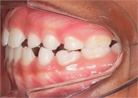 Photos eight months after treatment initiation: a) front intraoral photo; b) right lateral intraoral photo; c) left lateral intraoral photo; d) overbite intraoral photo; e) frontal extraoral photo;  f) smiling frontal extraoral photo; g) profile extraoral photo