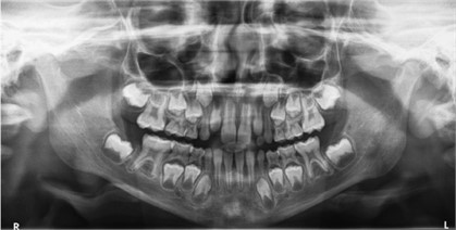 Panoramic X-ray 1 year after treatment initiation