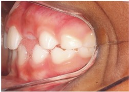 Intraoral photos one year after the start of treatment: a) frontal intraoral photo; b) right lateral intraoral photo; c) left lateral intraoral photo