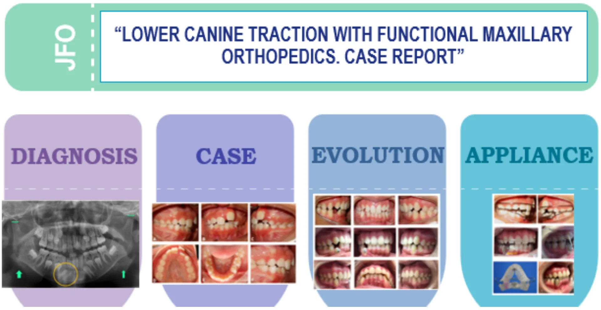 Lower canine traction with jaw functional orthopedics. case report