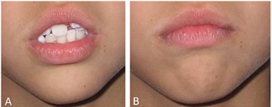In this image the difference in shape of the hemimandibles can be seen: a) note the dryness of the lips due to the lack of closure, b) upon forcing closure of the lips, the chin’s hypertonicity becomes visible