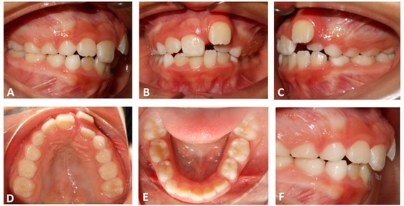 Intra-oral photographs in which the beginning of the treatment is depicted: a) note the flat occlusal plain with physiological wear, b) the upper left incisor protrudes and is superimposed upon the lateral incisor, c) complete lack of space for the inferior canine, d) superior arcade lacking transversal development, e) non-symmetric shape of the arcade due to lack of development,  f) note the protrusion of the superior incisors