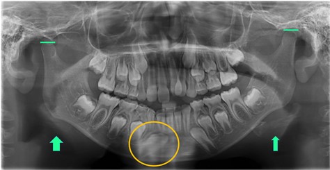 Panoramic x-ray in which the asymmetry and the position of tooth 43, which was classified as a type 1 canine transmigration on Mupparapu’s scale, can be observed