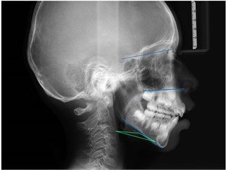 This x-ray shows the divergent horizontal plains, as well as the inverted hyoid triangle