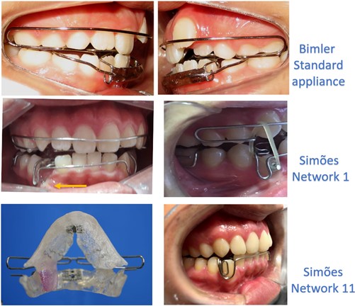 Standard Bimler Appliance used at the beginning of the treatment. At a later stage, an SN1  was used since in addition to its attributes to stimulate development at the sagittal and transversal sense,  it favors anchorage for traction of the lower tooth. Subsequently, it was placed an SN11  with an accessory to correct the canine rotation