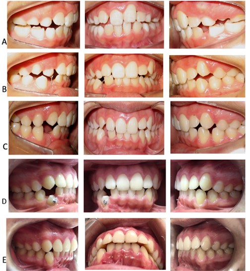 a) At age 9.6 years, the increase of the patient’s space for tooth 33 and the alignment of the anterior-upper segment can be observed; b) At age 10, the patient is remitted to the surgeon to bind the canine and initiate traction. Note how the middle line is deviated; c) The cut in the wire that was applying traction to tooth 43 can be observed. The complete space for tooth 33 is also visible, but this tooth is in canine class II; d) Eruption of tooth 43 began with a rotation. On the left side, the canines are already oriented into class I; e) The improved position of tooth 43 and the middle line are visible. On the left side, the upper and lower canines have erupted with a class I for canines and molars