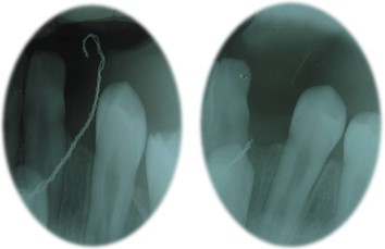 It is observed that the wire with which the canine was being pulled is cut, for which an x-ray was taken in which it can be seen how tooth 43 had become aligned with its eruption corridor.  For this reason, it was not necessary to perform a surgical procedure again