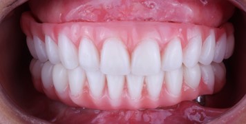 Extraoral photographs before and after the installation of implant prosthesis