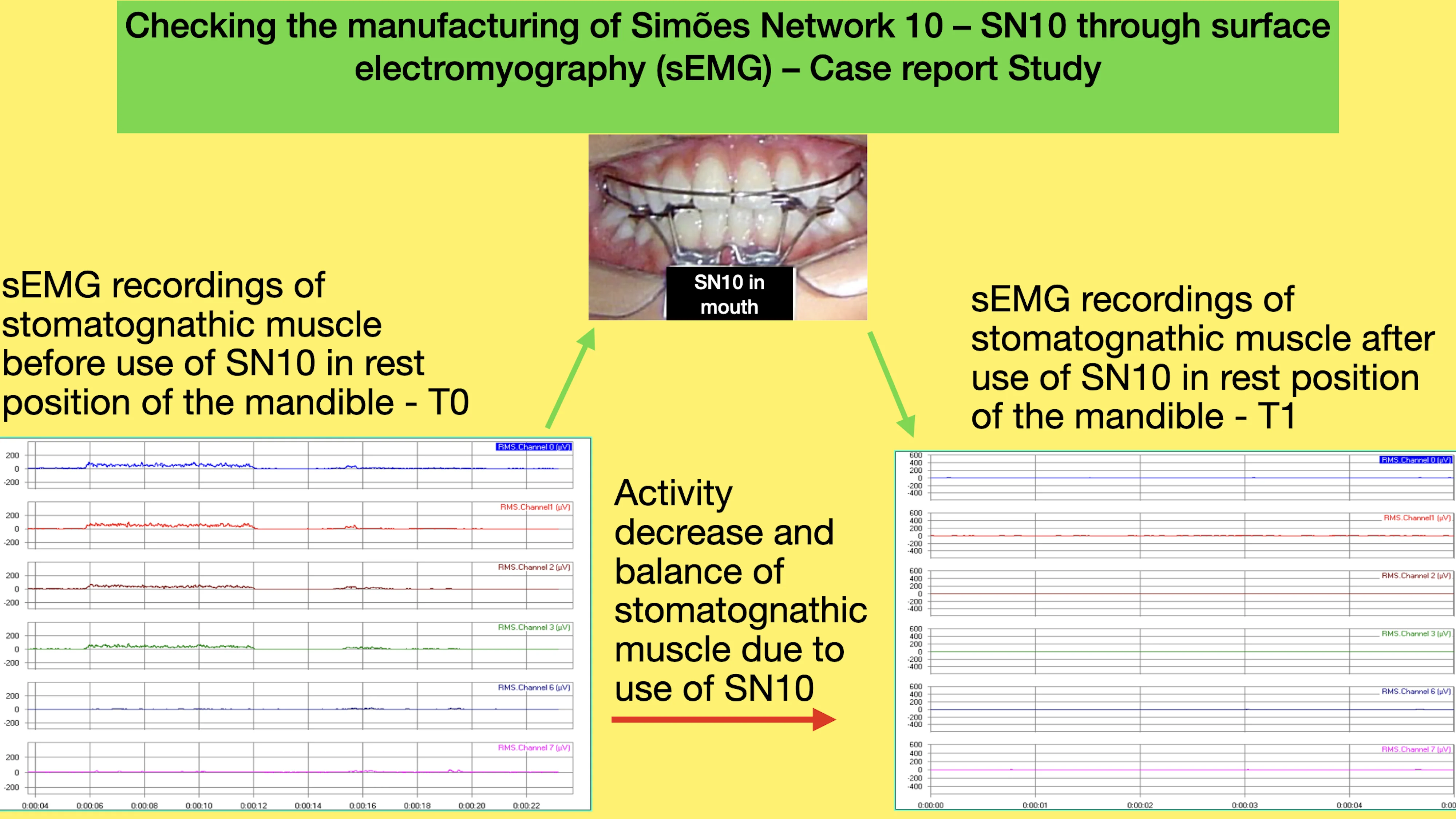 Checking the manufacturing of Simões Network 10 – SN10 through surface electromyography (sEMG) – Case report Study