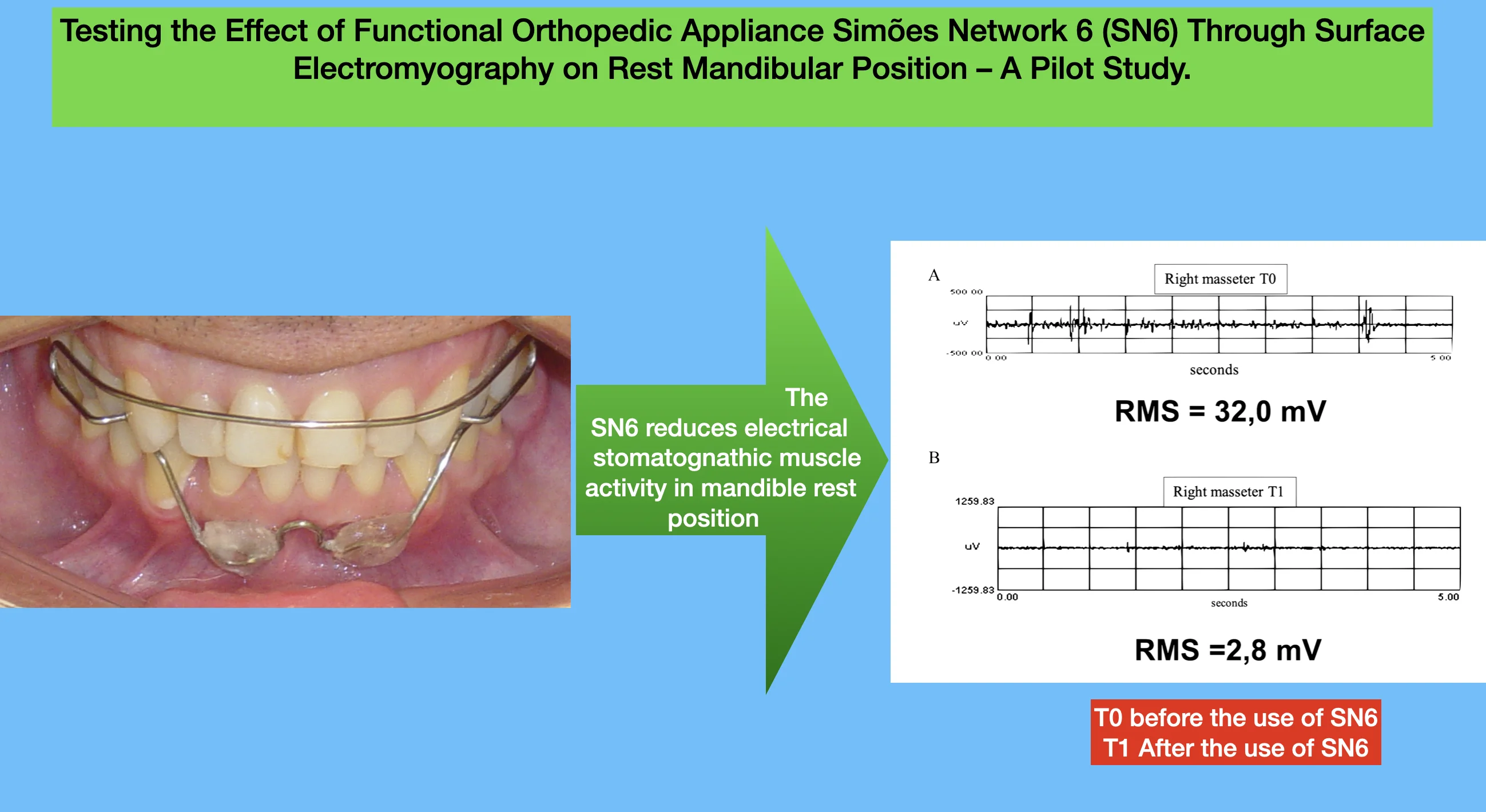 Testing the effect of functional orthopedic appliance Simões network 6 (SN6) through surface electromyography on rest mandibular position – a pilot study