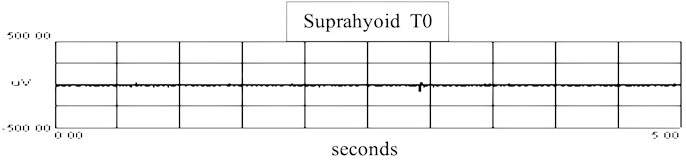 sEMG recordings of suprahyoid muscle: a) sEMG recordings in T0 of suprahyoid muscle in T0 with RMS, b) recordings in T1 of suprahyoid muscle with RMS