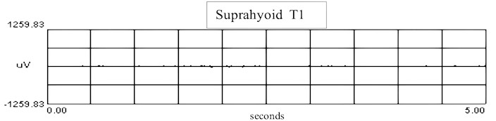 sEMG recordings of suprahyoid muscle: a) sEMG recordings in T0 of suprahyoid muscle in T0 with RMS, b) recordings in T1 of suprahyoid muscle with RMS