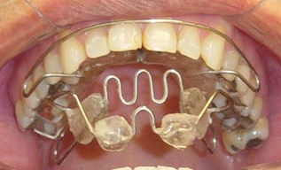 SN6 installed in patient’s mouth. In the upper image the buccal arch can be seen in the maxilla.  I the mandible the descent of the dorsal arch to hold the special shields and the inverted “V”  that join the left and right special shields. The special shields are made in acrylic  and its superior part can also be seen. In the middle image patient