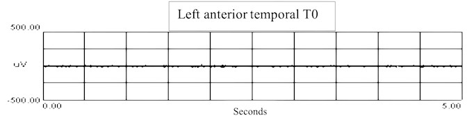 sEMG recordings of left temporal muscle: a) sEMG recordings in T0 of left anterior temporal muscle in T0 with RMS, b) recordings in T1 of left anterior temporal muscle with RMS in yellow
