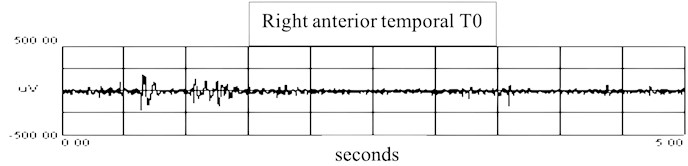 sEMG recordings of right temporal muscle: a) sEMG recordings in T0 of right anterior temporal muscle in T0 with RMS, b) recordings in T1 of right anterior temporal muscle with RMS