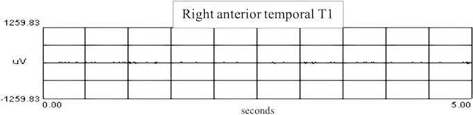 sEMG recordings of right temporal muscle: a) sEMG recordings in T0 of right anterior temporal muscle in T0 with RMS, b) recordings in T1 of right anterior temporal muscle with RMS