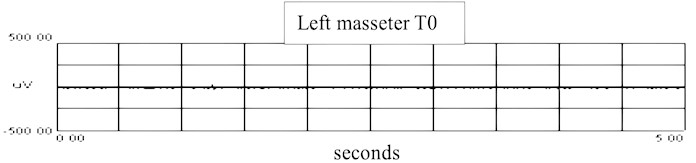 sEMG recordings of left masseter muscle: a) sEMG recordings in T0 of left masseter muscle  in T0 with RMS, b) recordings in T1 of left masseter muscle with RMS