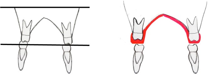 Schematic drawing showing the difference in thickness of the encapsulation  to compensate for the inclination of the occlusal plane in relation to the Camper Plane