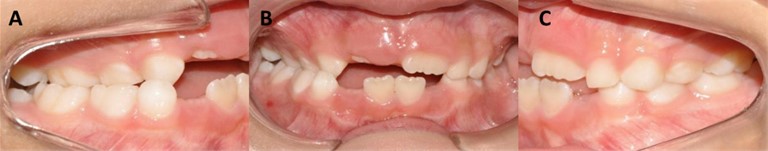 Initial intra-oral photographs of a) the right side, b) front, c) left side. Patient with Unilateral PCB, absence of teeth 11, 31 and 41. Half-erupted tooth 22 and distocclusion. Initial radiographic  examination with d) panoramic radiograph, e) lateral cephalogram