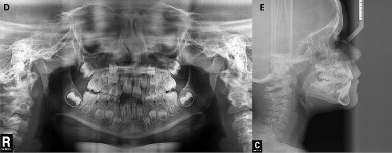 Initial intra-oral photographs of a) the right side, b) front, c) left side. Patient with Unilateral PCB, absence of teeth 11, 31 and 41. Half-erupted tooth 22 and distocclusion. Initial radiographic  examination with d) panoramic radiograph, e) lateral cephalogram