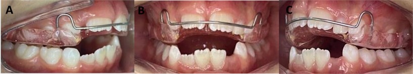 Installation of the apparatus Maurício expander with midline centering.  Activation: 1/4 turn weekly. Intra-oral photographs of the a) right side, b) front, c) left side