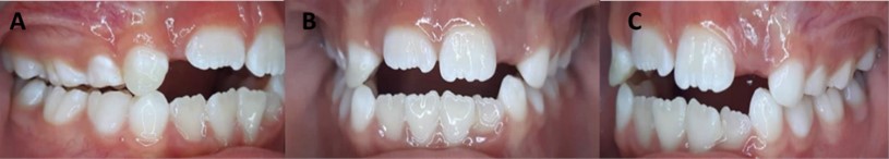 Intra-oral photographs of the a) right side, b) front, c) left side,  after 7 months of the treatment, with selective wear and PDP in the 53