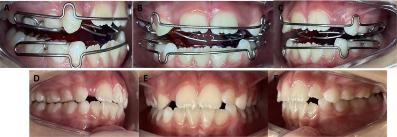 Installation of the apparatus Planas Indirect Tracks. Activation: 1/4 turn months. Intra-oral photographs of the a) right side, b) front, c) left side. Final intra-oral photographs of the d) right side, e) front, f) left side, after 10 months of the treatment. The patient continues to undergo treatment