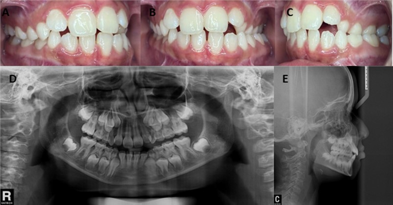 Initial intra-oral photographs of the a) right side, b) front, c) left side. Patient with Unilateral PCB, and distocclusion. Initial radiographic examination with d) panoramic radiograph, e) lateral cephalogram