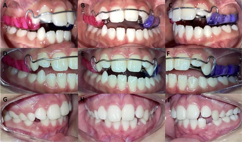 Installation of the apparatus Maurício expander with midline centering obtained by adjusting the acrylic. Activation: 1/4 turn weekly. Intra-oral photographs of the a) right side, b) front, c) left side. Removal of the acrylic from the 53 and 63 region and carrying out selective grinding and creation  of the PDTs, of the d) right side, e) front, f) left side. Final intra-oral photographs of the g) right side,  h) front, i) left side, after 7 months of the treatment. the patient continues to undergo treatment