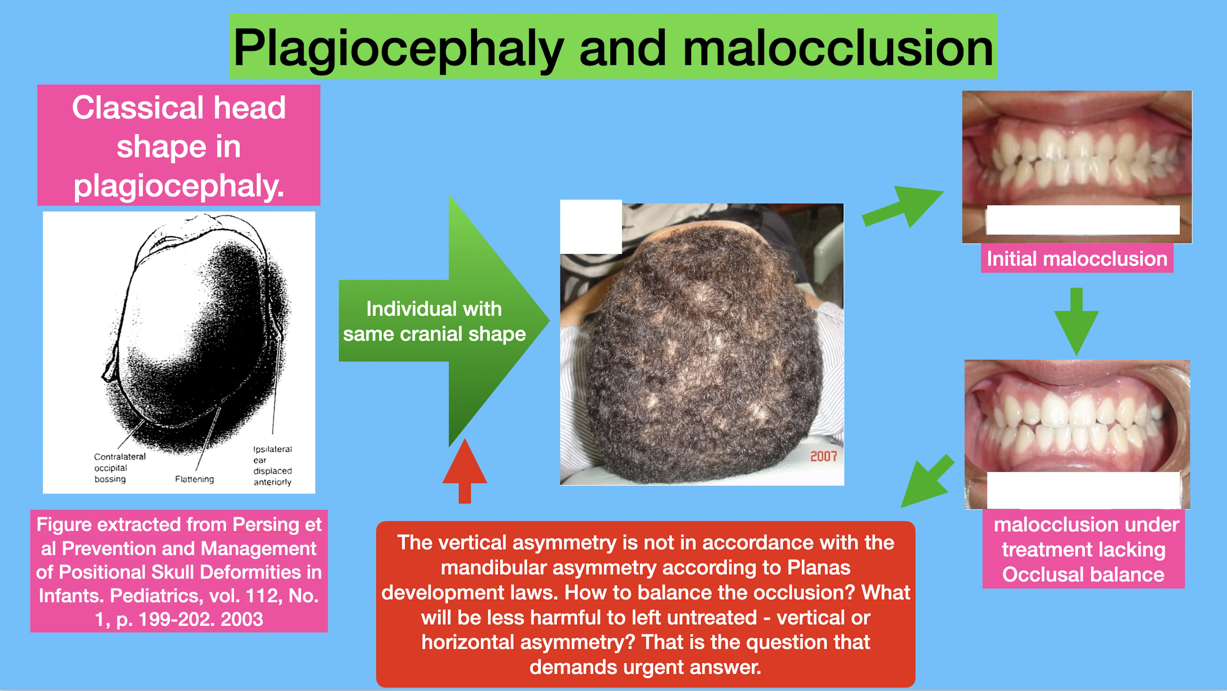 Plagiocephaly and malocclusion