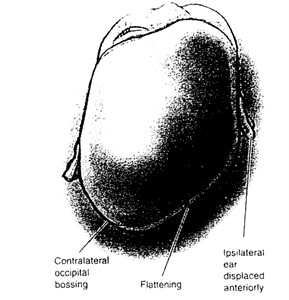 Classical head shape in plagiocephaly.  Figure extracted from Persing et al. [1]