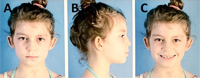 Extraoral photography after 12 months of treatment, frontal, profile  on the right side and smile, with changes in lip, facials, muscles and aesthetic