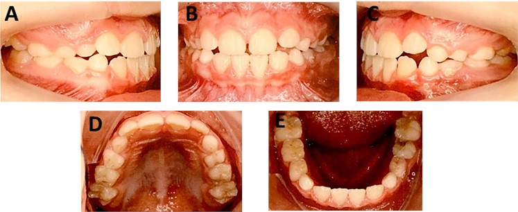 a) Intraoral photography after 12 months of treatment, right lateral; b) frontal;  c) left lateral, d) occlusal of the maxilla and e) mandible