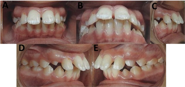 a) Initial intra-oral photographs of the patient frontal; b) inferior overjet view;  c) lateral overjet view; d) right lateral and e) left lateral