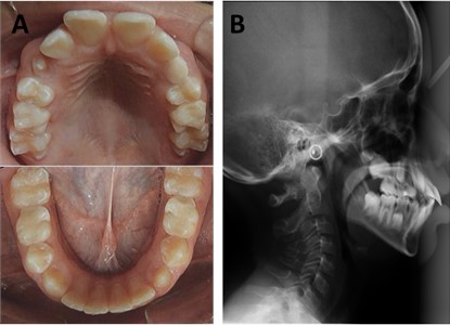 a) Initial occlusal photographs of the maxilla and mandible; b) initial teleradiography