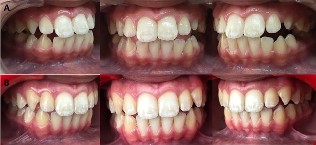 a) Use appliance for 3 months in initial intra-oral photographs of the patient frontal,  right lateral and left lateral; b) use appliance for 6 months in initial intra-oral photographs  of the patient frontal, right lateral and left lateral