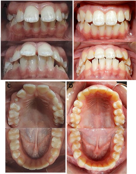 a) Initial intra-oral photographs of the patient frontal and inferior overjet view;  b) intra-oral photographs of the patient frontal and inferior overjet view after 12 months of treatment;  c) initial occlusal photographs of the maxilla and mandible; d) occlusal photographs  of the maxilla and mandible after 12 months of treatment