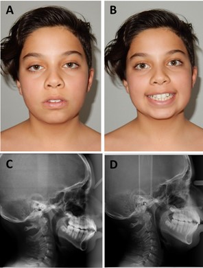 a), b) Changes aesthetic and facials muscles; c), d) radiography changes in growth mandibles