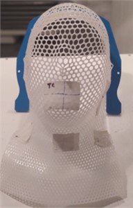 Photograph of a radiotherapy mask manufactured by additive manufacturing. This mask is used to immobilize the patient during radiotherapy sessions in the head and neck region.  Photo credits: Author RFN, 2023