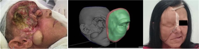 Example of virtual modeling and application of 3D printing in a customized facial prosthesis  for a patient with squamous cell carcinoma lesion [19]