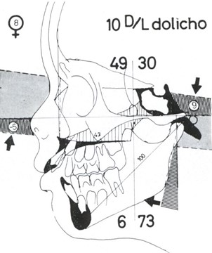 Micro-rhinic Dysplasia – Meso-rhinic Normoplasia. Comparison of the Fig. 1 and 3 and a hypothetical tracing of the same case with her anatomical units in a normoplastic layout  with a meso-rhinic nose. Thus, the Cl.II and the open bite disappear automatically