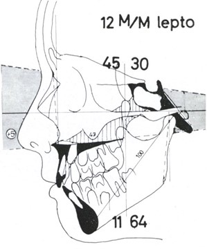 Micro-rhinic Dysplasia – Meso-rhinic Normoplasia. Comparison of the Fig. 1 and 3 and a hypothetical tracing of the same case with her anatomical units in a normoplastic layout  with a meso-rhinic nose. Thus, the Cl.II and the open bite disappear automatically