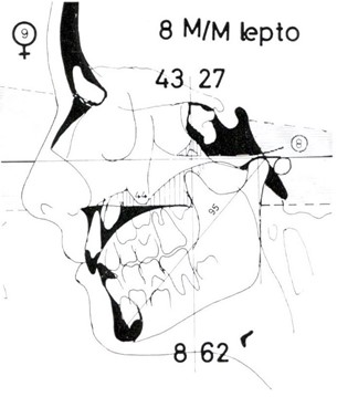 Micro-rhinic Dysplasia – Meso-rhinic Normoplasia. Comparison of two siblings with same-size anatomical units in a dysplastic layout in the brother and a normoplastic arrangement in the sister, as a confirmation of the previous hypothetical tracing, via respective findings in the clinical cases