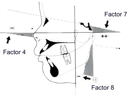 The rotational syndrome of the micro-Rhinic Dysplasia (“Cephalometric Triad”, Bimler). 1. Upward-tilted ANS-PNS line (Factor 4); 2. Hyperflected Mandible (Factor 8); 3. Increased inclination of the NS-line (Factor 7). The shift of the dental skeleton units against each other causes a Class II occlusion