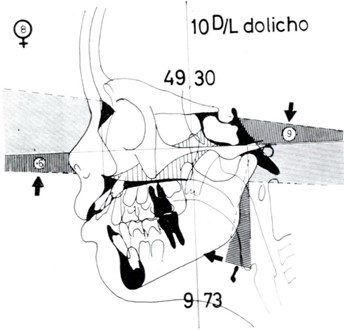 Micro-rhinic Dysplasia – Orthognathic Mid Face. The Formula “10 D/L dolicho” shows the typical D/L shift which are predominant in Frontal Open Bite cases. Our Factor Analysis with the negative F4  and F8 reveals the mechanism of the facial dysplasia as a clockwise rotation, in relation to FH