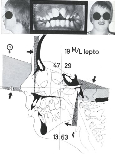 Micro-rhinic Dyplasia – Rotational Prognathia. The formula “19 M/L lepto” shows the higher convexity of the face. The Factor Analysis reveals this partly as a prognatic maxilla (positive F1: N-A), partly as a posterior position of the chin (high F2: A-B). The extreme inclination of the cranial base F7  (N-S) towards the FH indicates that it is involved in the rotational process. This is expressed also by a steeper Clivus Inclination (F8: tangent to posterior board of the Clivus). This increases the angle between Clivus and Maxilla and puts it into the meso-prosopic values (“M” of the formula). A high maxillary alveolar process stops the compensatory closing movement of the mandible, hence the F decreases  and the F2 increases, so does the Open Bite. The consequence is a vertically high face (“lepto”).  The T-TM distance of 29 mm belongs to the medium size range