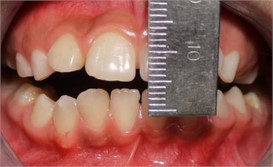 a) Mouth opening 1,5 mm, b) frontal facial view, asymmetry, c) right lateral facial view,  mandibular retrognathia, d) left lateral facial view, muscle contraction.  Image courtesy: Od. S. Siverio, and Od. M. Carreras. Residents of the postgraduate course of Maxillofacial Surgery of the University Military Hospital ¨Dr. Carlos Arvelo¨