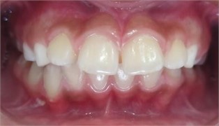 Intraoral condition: a) Simões Network 3 sectioned, b) frontal intraoral view, c) lateral intraoral view, increased overjet 8 mm, d) deviated midline before SN3, e) centered midline after SN3