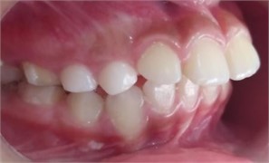 Intraoral condition: a) Simões Network 3 sectioned, b) frontal intraoral view, c) lateral intraoral view, increased overjet 8 mm, d) deviated midline before SN3, e) centered midline after SN3